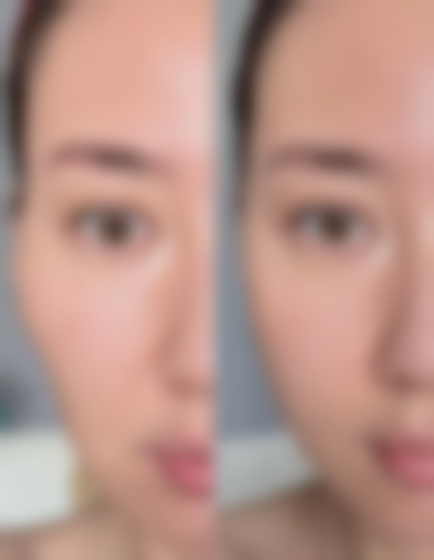 去增生疤痕怎么办？掌握涂抹药膏、激光治疗等有效方法告别增生疤痕困扰