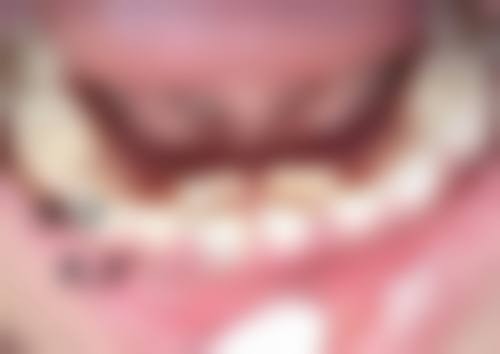 眼袋切了还会长吗？了解术后复发因素及应对办法，让你告别眼袋烦恼