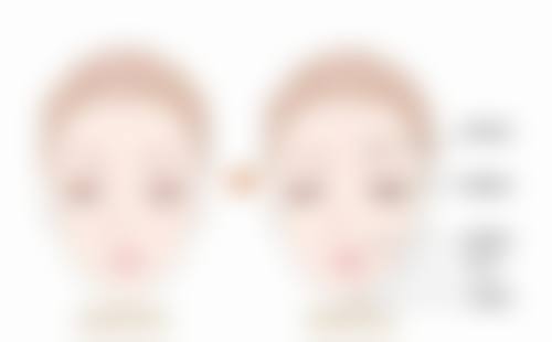 三、眼袋复发的应对办法