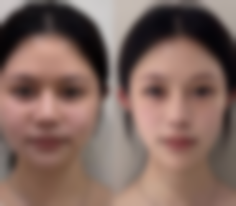 五、吸脂有什么危害之神经损伤