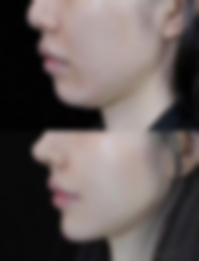 七、吸脂有什么危害之持续疼痛