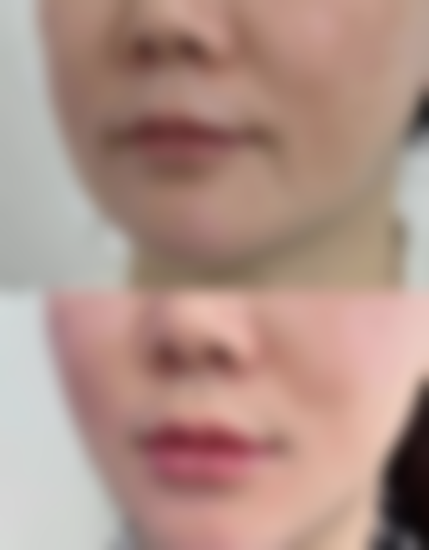 三、吸脂有什么危害之麻醉反应