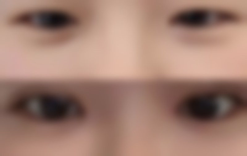 二、肉毒素注射解决眉眼间距问题