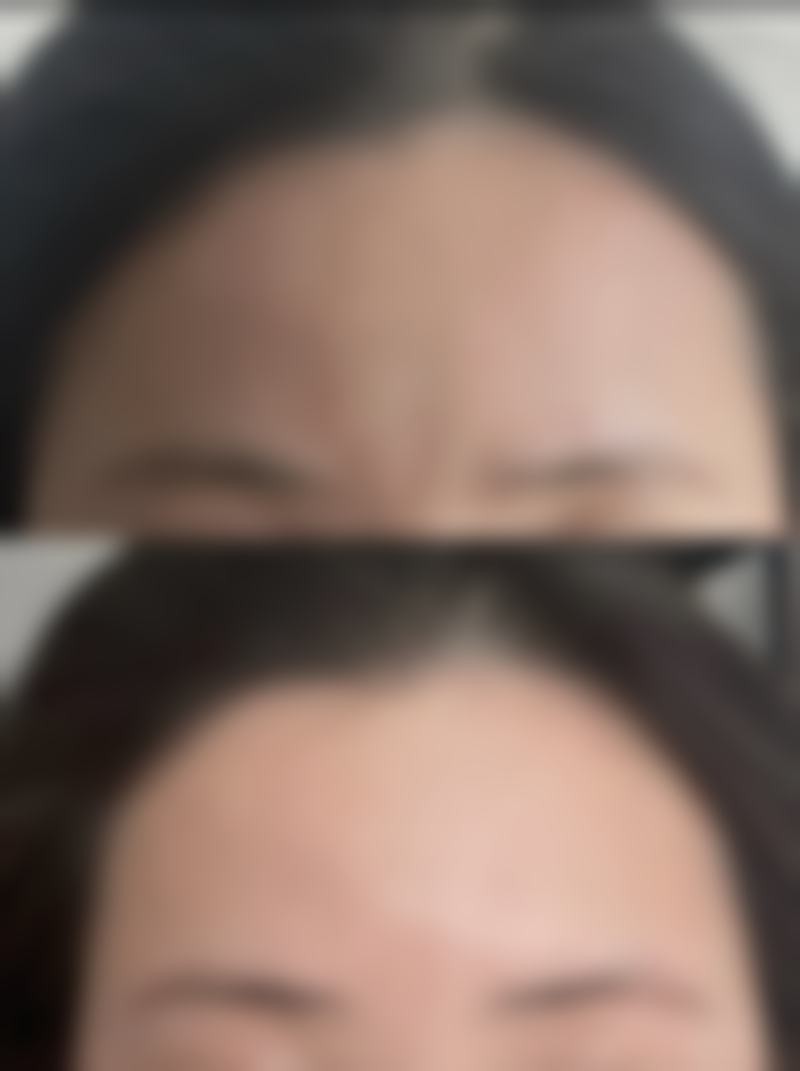 三、手术调整改善眉眼间距问题