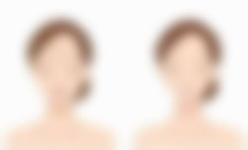 六、如何选择适合自己的埋线双眼皮方法