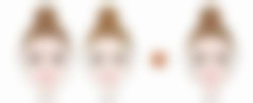 三、间断埋线法