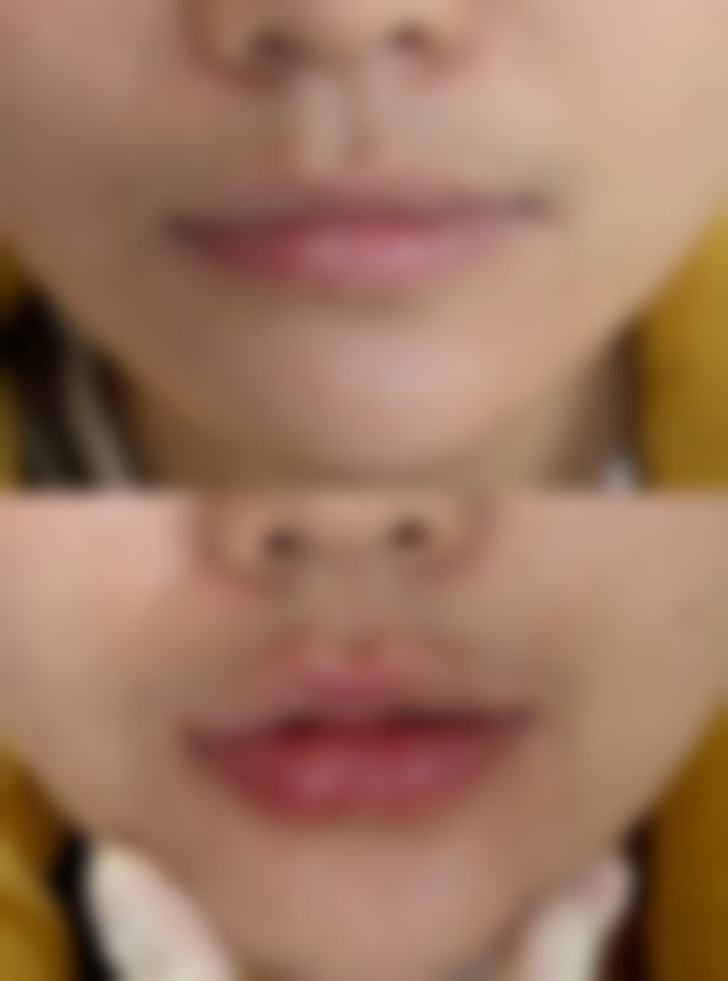 脸上磕伤了缝针的疤痕能消吗？了解这些方法，让疤痕淡化不再留疤！ 