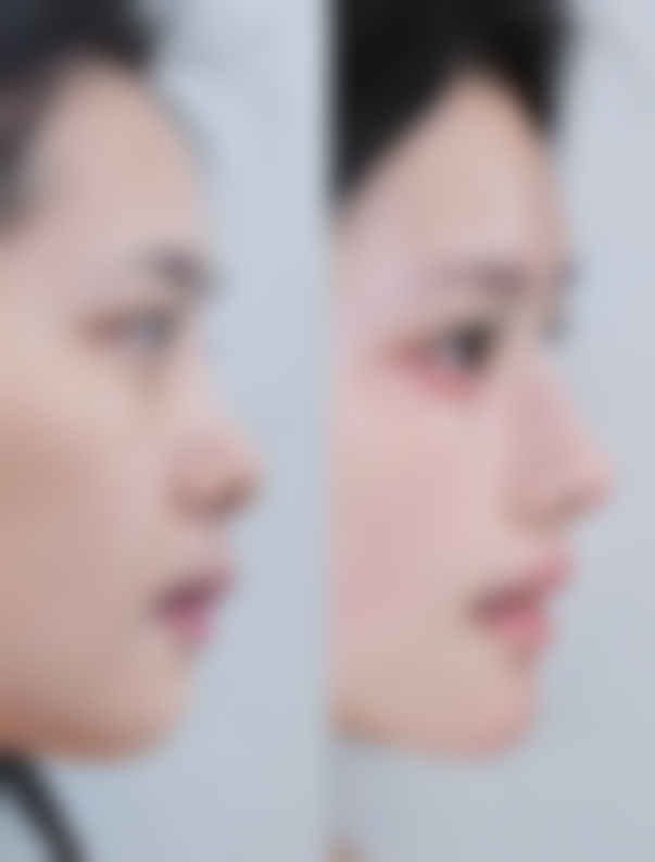 六、双眼皮不对称修复的费用问题