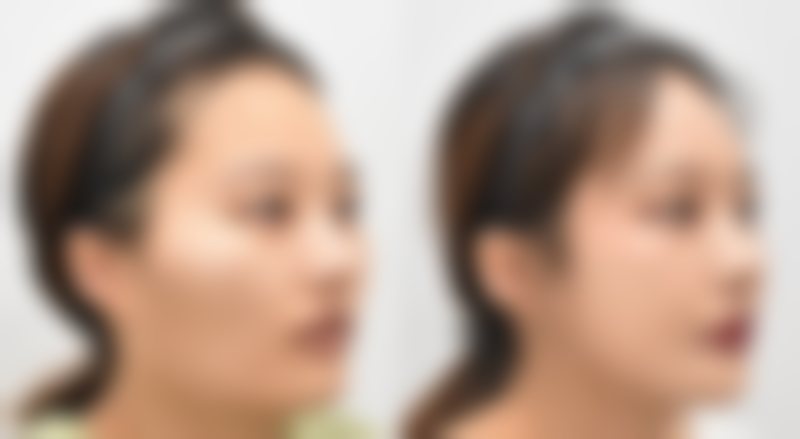 五、总结：假体隆胸影响生育吗？