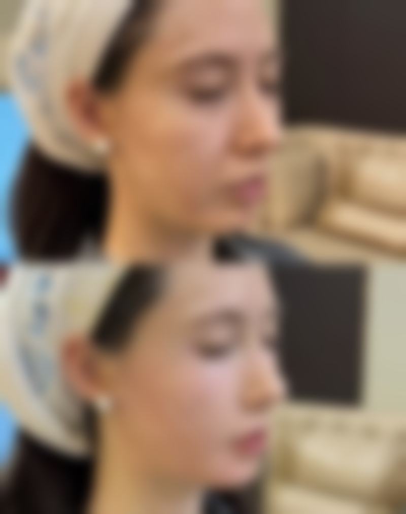 二、假体隆胸对生育各方面的影响