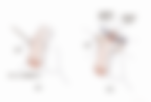 二、20年的疤痕消除之激光疗法