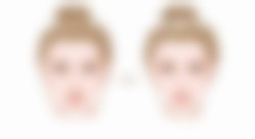 五、预防隆鼻后鼻子不通气的小建议