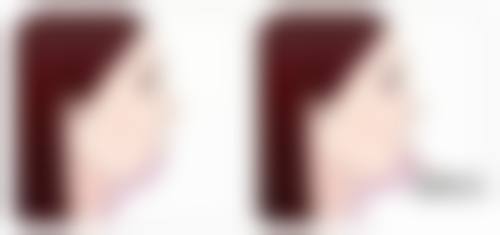 三、避免剧烈运动，减少伤口压力