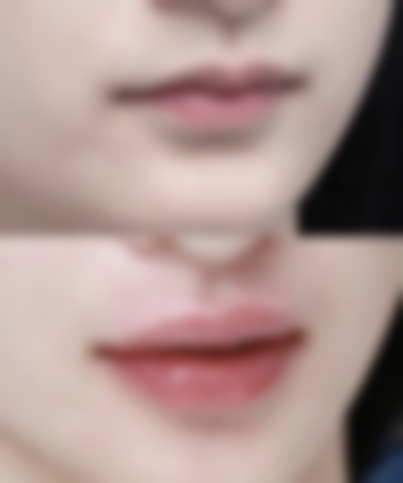 五、外切眼袋手术实例分享