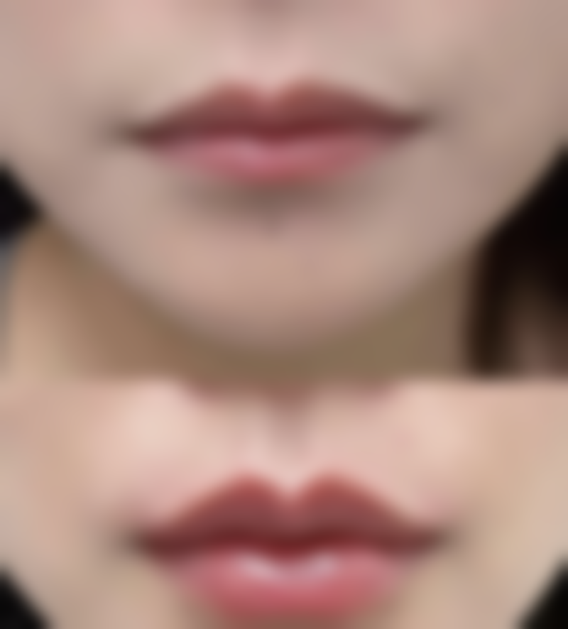 20年的疤痕怎么消除？激光疗法、手术治疗等方法助你改善旧疤外观