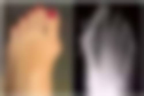 一、经常打瘦脸针的常见危害