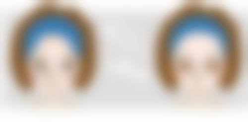 激光能去除疤痕疙瘩吗？专家解读效果及相关图片展示助你了解真相 