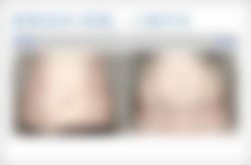 四、割双眼皮术后的注意事项