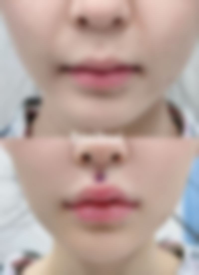 空姐身上有疤痕是怎么去掉的呢？遮瑕、激光、手术等方法来揭秘 