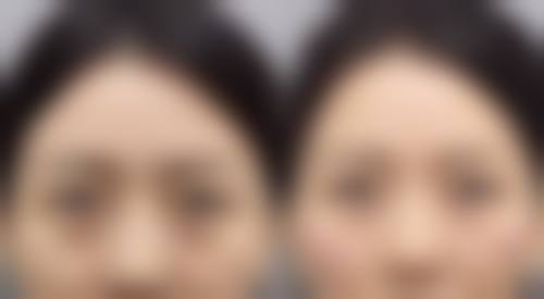 五、割双眼皮拆完线后可能出现的问题及处理方法