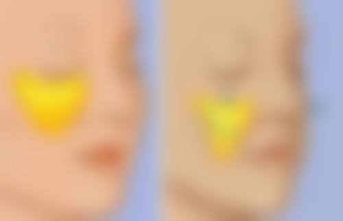 三、割双眼皮拆完线多久可以洗头