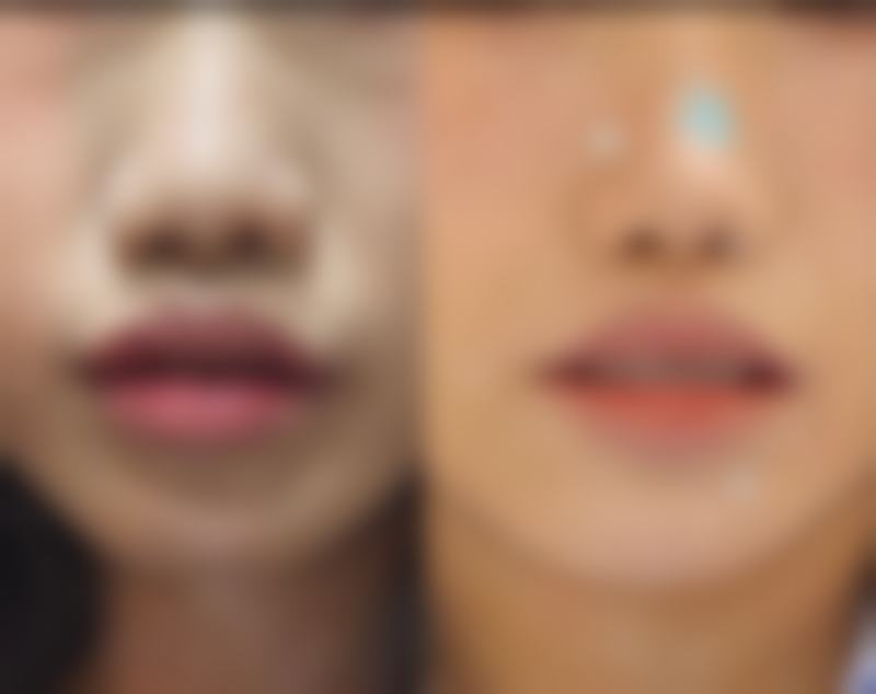 一、医美去除眼袋的常见手术方式及成效维持时间