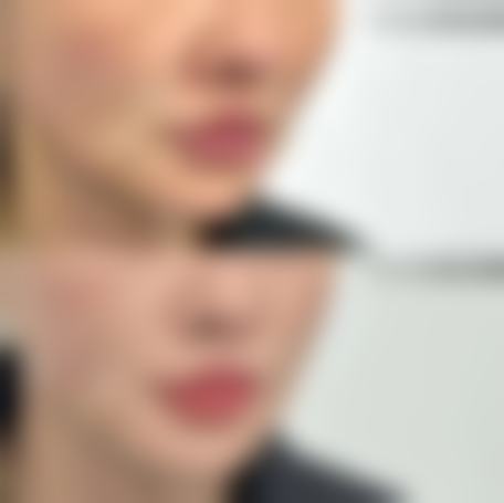 四、割双眼皮拆完线后促进修复的方法