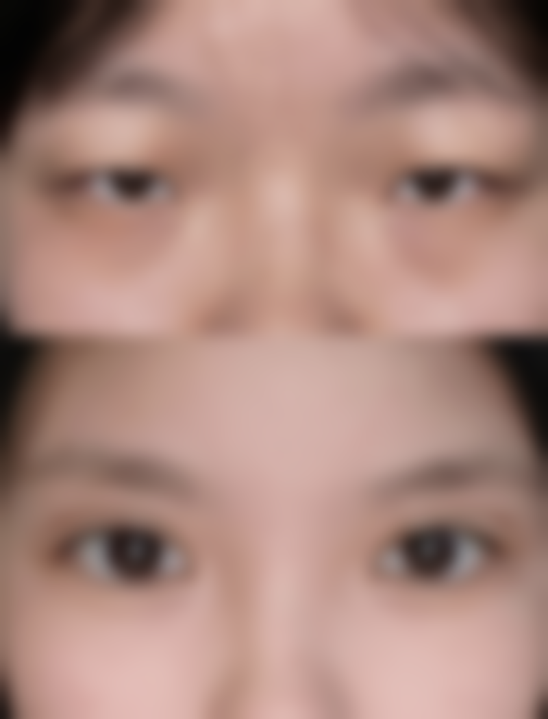 三、瘦脸针只打一次有效吗——单次注射成效的维持时长