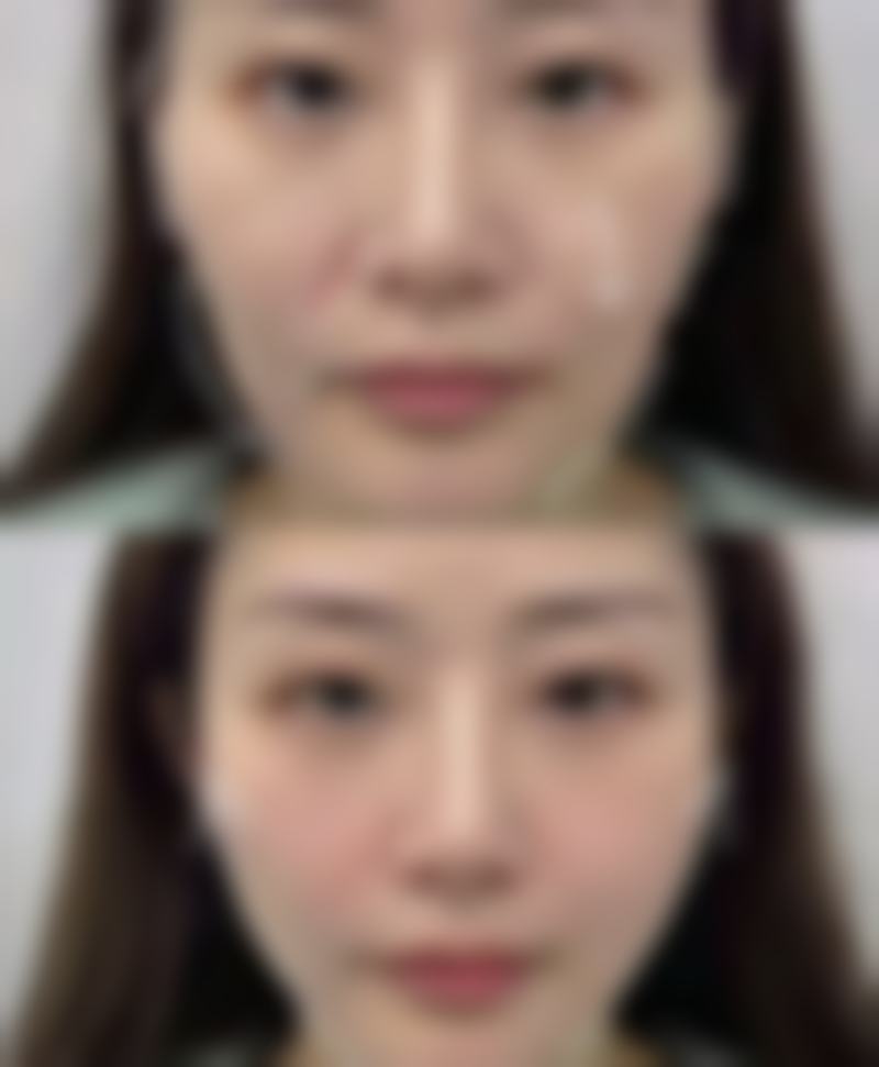 疤痕可以淡化到什么程度？切缝疤痕淡化效果及影响因素大揭秘！ 