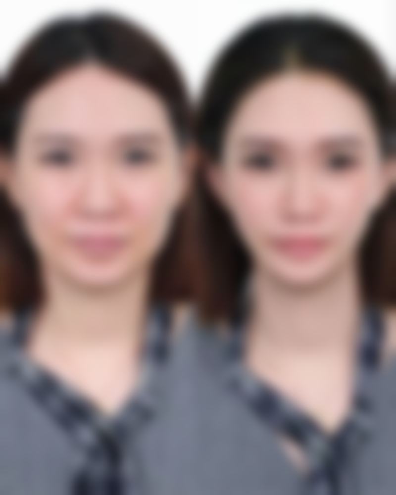 二、影响医美去除眼袋成效维持时间的因素