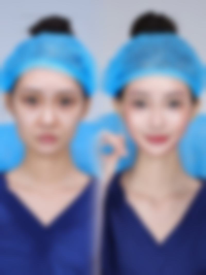 二、激光治疗改善孩子脸上凹陷疤痕