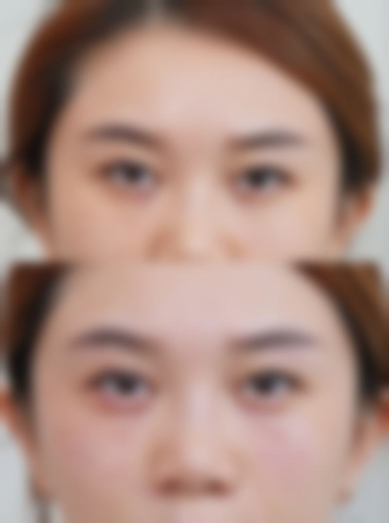 四、饮食调理助力孩子脸上凹陷疤痕淡化