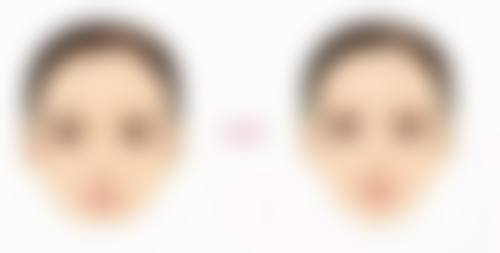 双眼皮做窄了还能修复吗？术后6个月可修复，附修复方法及参考图片 
