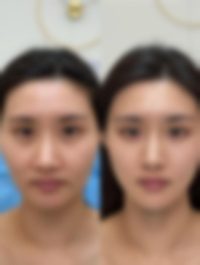 四、影响自体隆鼻成效的其他因素