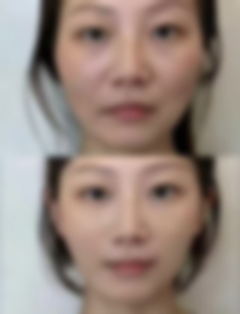 三、手术方法的选择要点