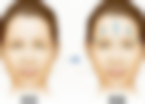 一、脸上烧伤的疤痕变黑的原因
