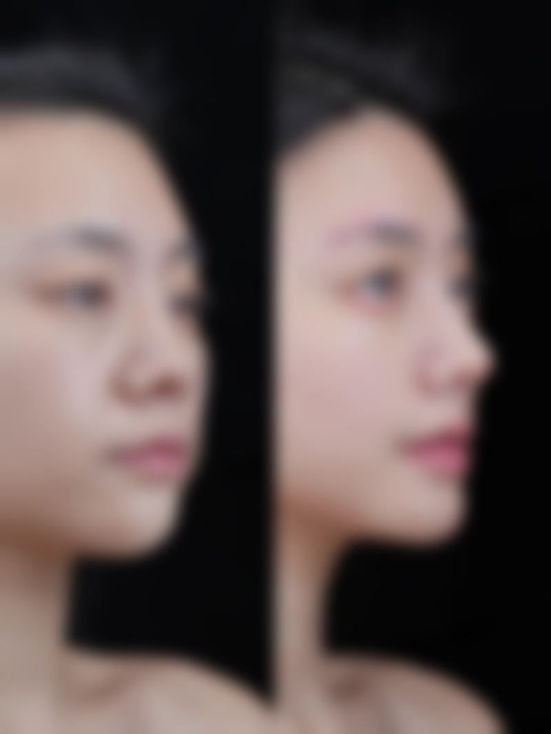 二、手术隆鼻是恒久的吗？持久性受哪些因素影响