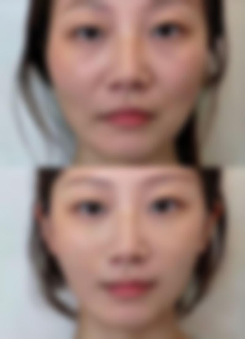一、手术隆鼻是恒久的吗？常见隆鼻方式大揭秘