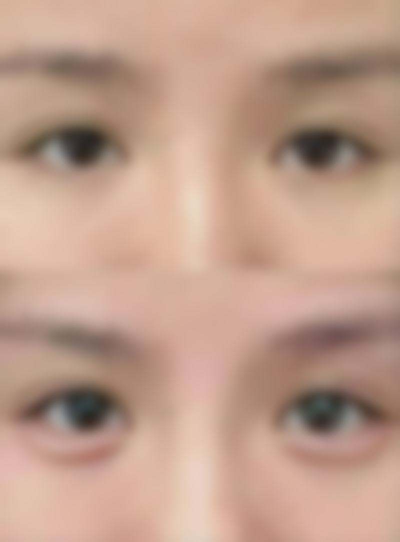 三、术后复查与拆线