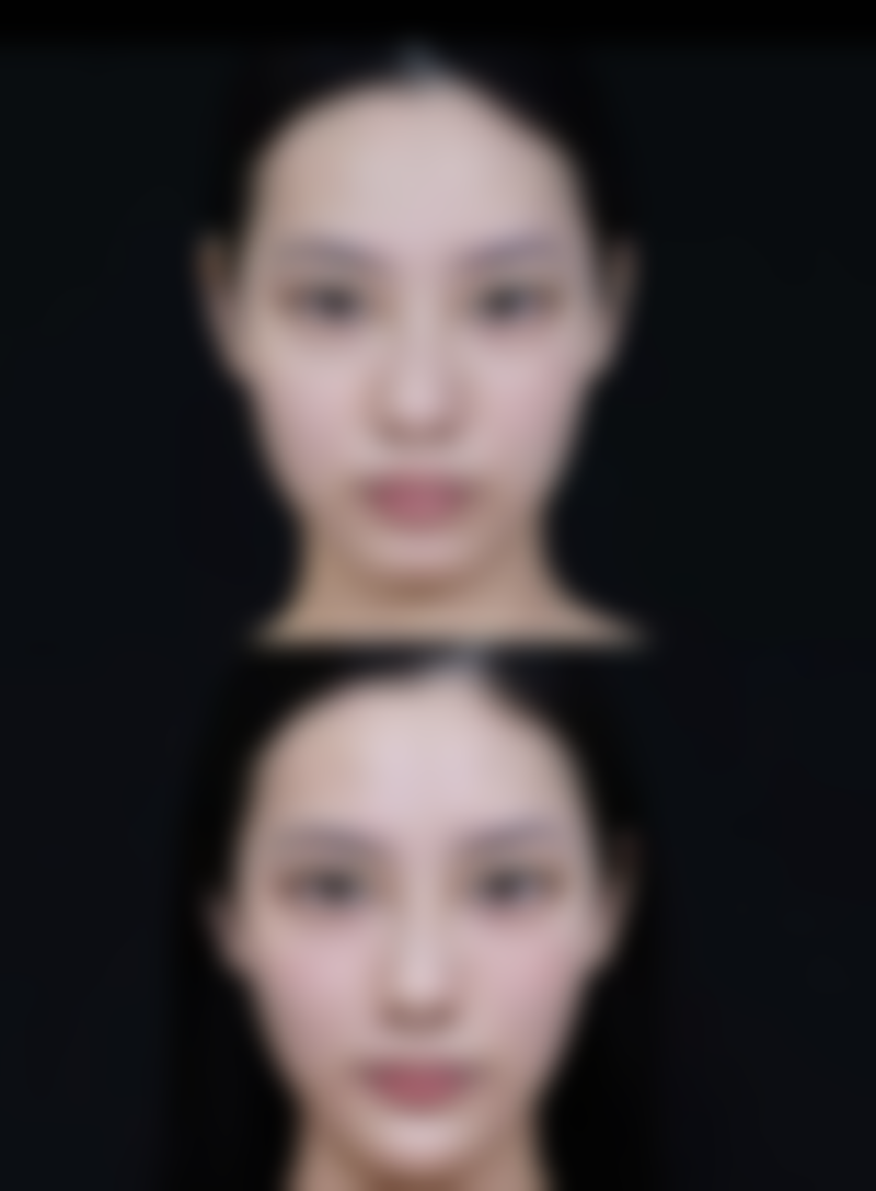 二、拆纱布后的注意事项