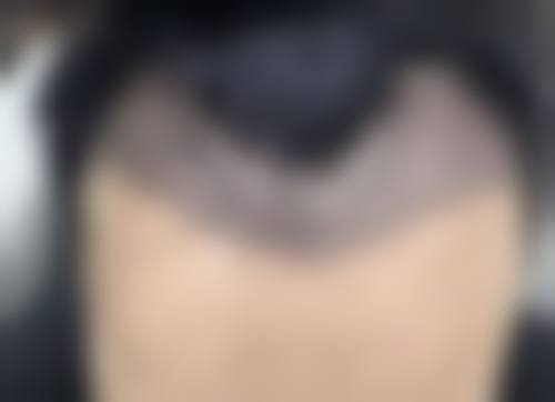 三、华美面部吸脂修复阶段及时间
