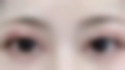 三、隆鼻可以只隆山根吗：局部隆鼻的成效