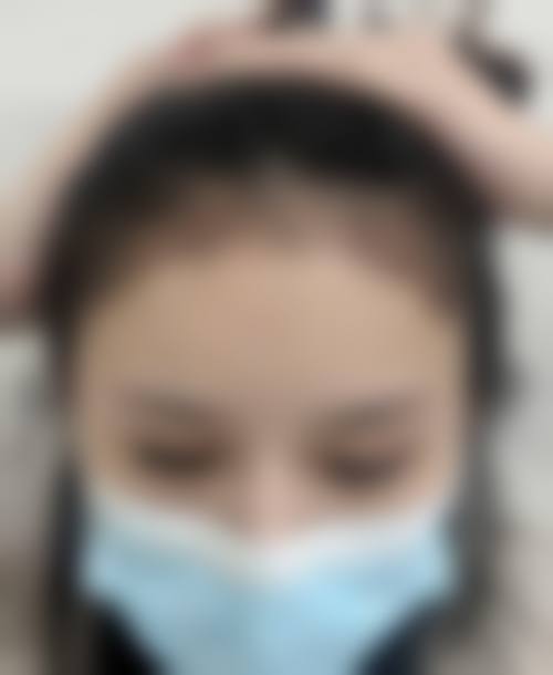 六、北京大麦微针植发价格表