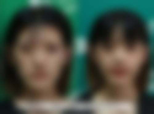 一、无痕双眼皮和全割的手术方式区别