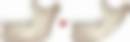 无痕双眼皮和全割有什么区别，手术方式、恢复时间、适应证全解析附图片
