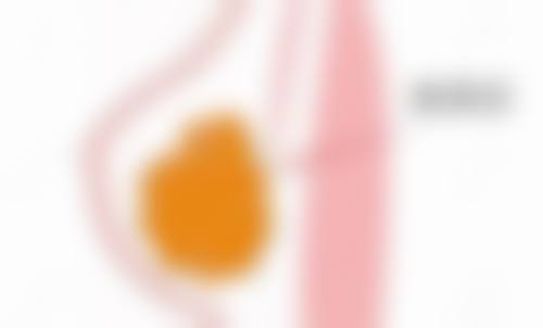 五、除皱针多长时间出成效:注意事项