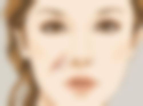 二、面部吸脂术的手术操作要点