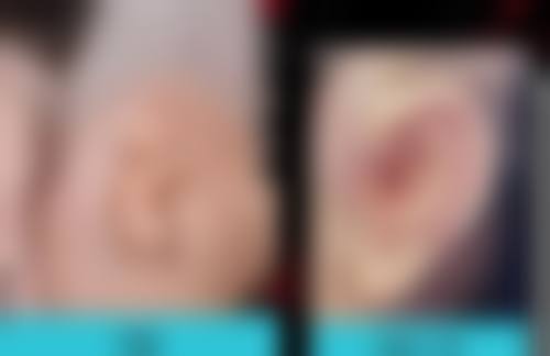 六、疤痕疙瘩患者的注意事项
