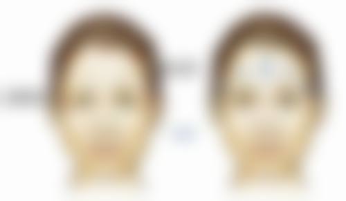 三、小综合隆鼻的优势