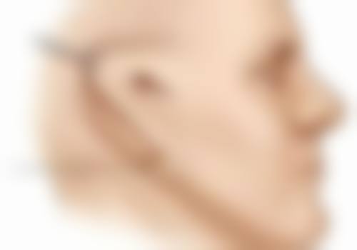 三、蒙克脸能去掉眼袋吗？看看真实实例